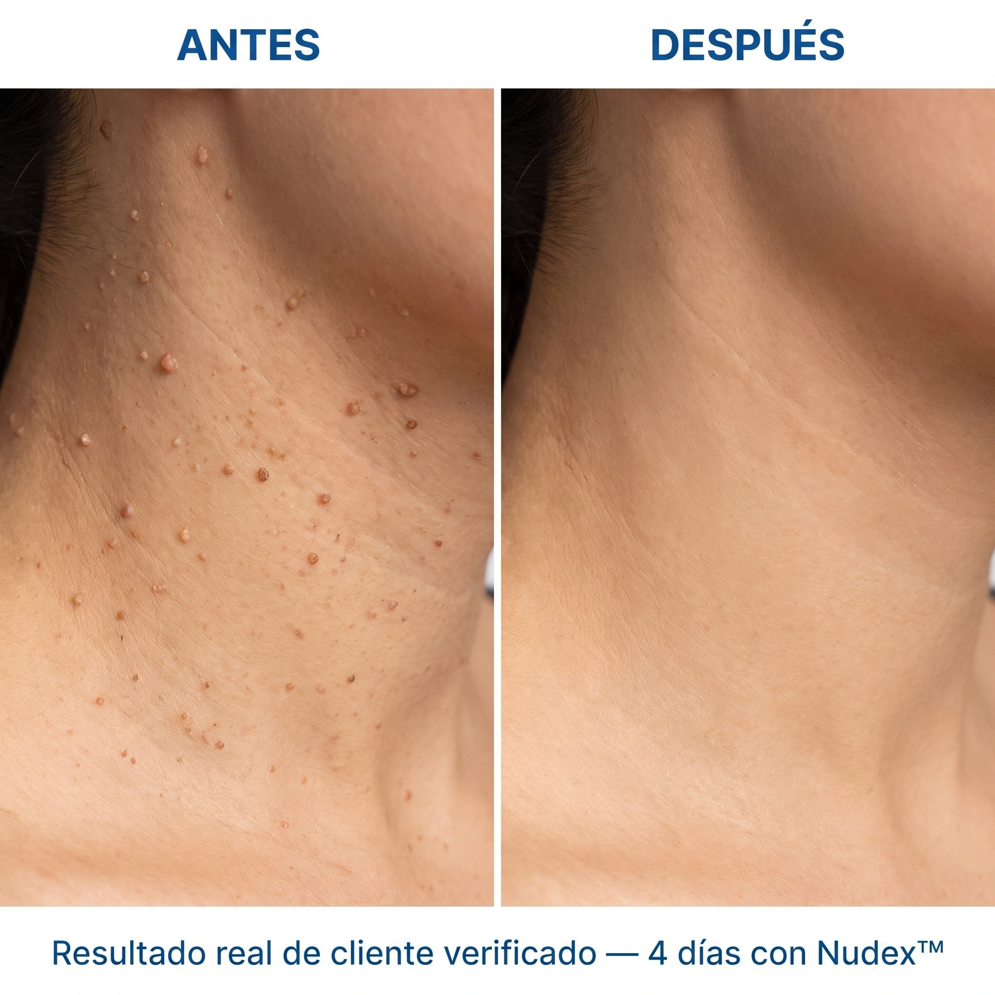 Nudex™ — Kit Eliminador de Fibromas