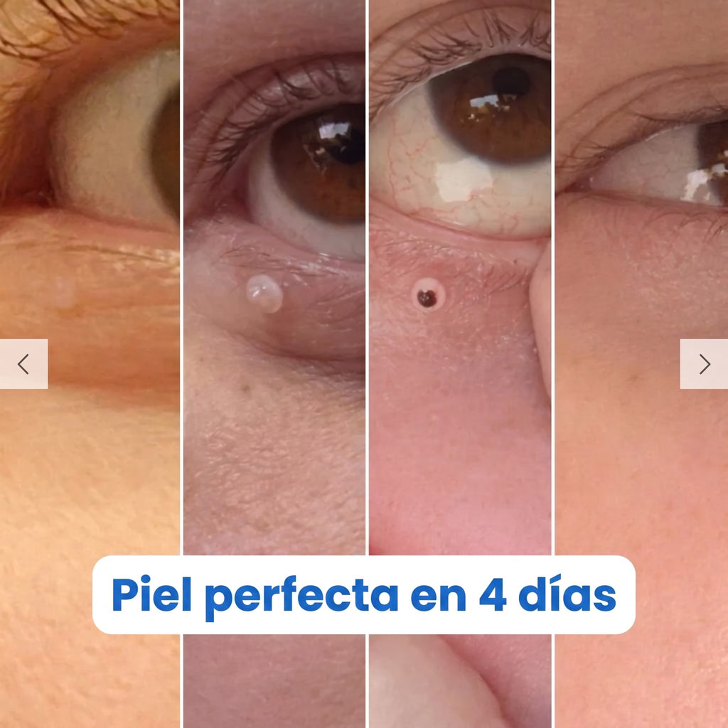 Nudex™ — Kit Eliminador de Fibromas