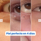 Nudex™ — Kit Eliminador de Fibromas