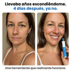 Nudex™ — Kit Eliminador de Fibromas